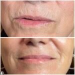 jet-plasma-skin-tightening-new-jersey-7