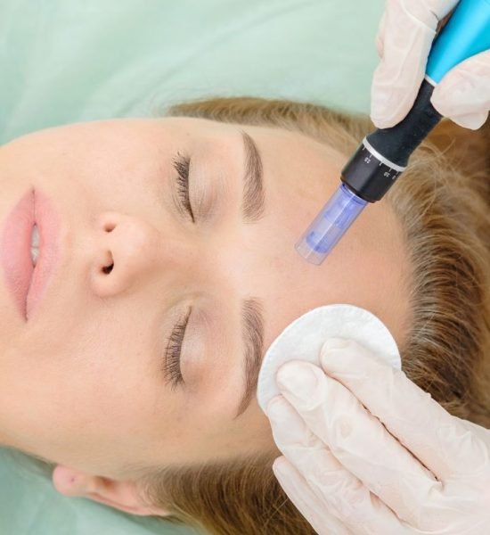 Last Chance to Get a Free Microneedling Treatment