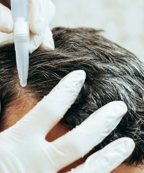 A cosmetologist performs anti-aging procedures, applies hyaluronic acid serum to the scalp