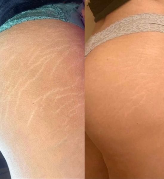 camouflage-stretch-marks-houston