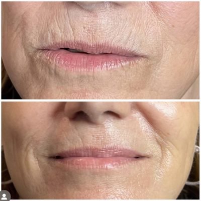 jet-plasma-skin-tightening-new-jersey-7