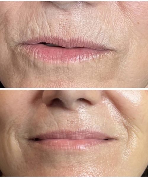 jet-plasma-skin-tightening-new-jersey-7