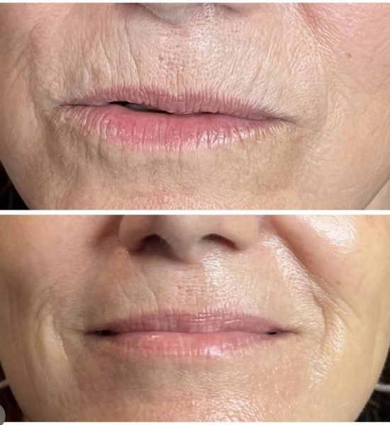 jet-plasma-skin-tightening-new-jersey-7